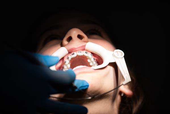 Receiving Traditional Braces From A General Dentist