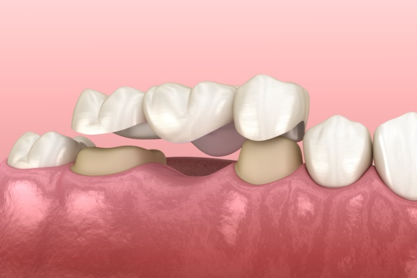 Caring For Your Dental Bridge: Tips For Longevity