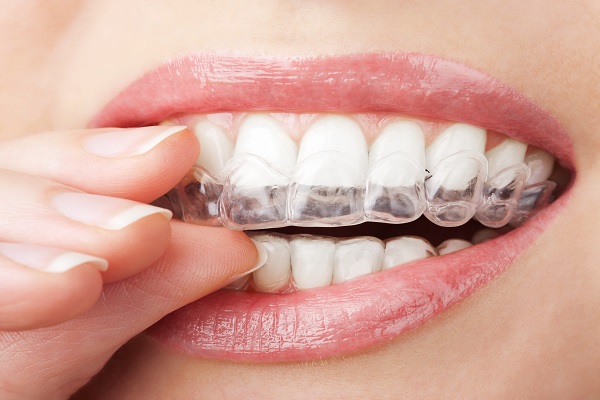 Invisalign - How Teeth Straightening Positively Impacts Your Oral